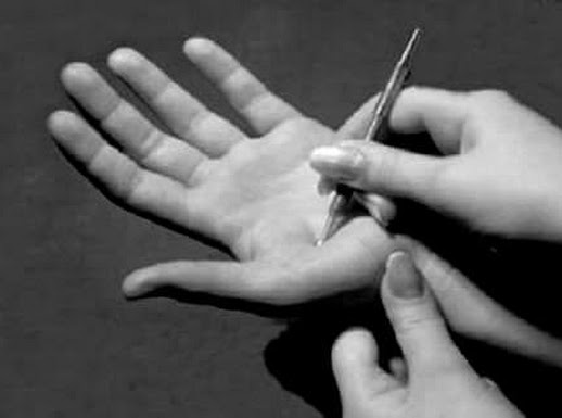 Sujok Therapy centre, ACUPUNCTURE CENTER,  service in Palai, Kottayam