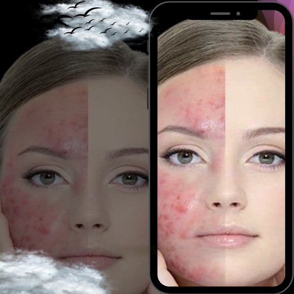 Pimple Treatment